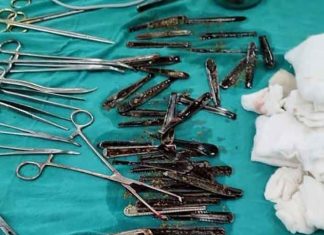 63 spoons found in man stomach UP