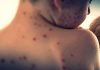 Measles cases