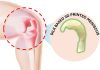 Ingenious therapies for knee meniscus tear