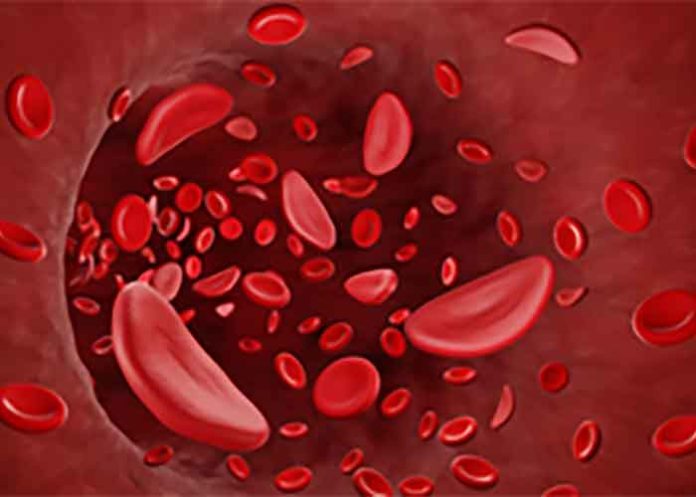 Sickle cell disease