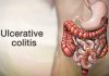 Ulcerative colitis