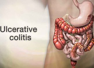 Ulcerative colitis