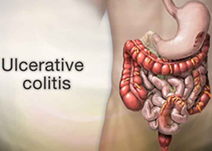 Ulcerative colitis