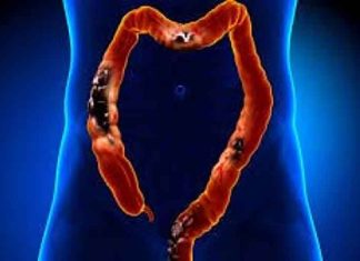 Stress worsens colorectal cancer