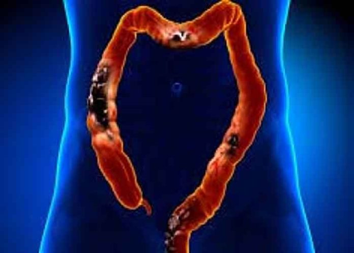 Stress worsens colorectal cancer