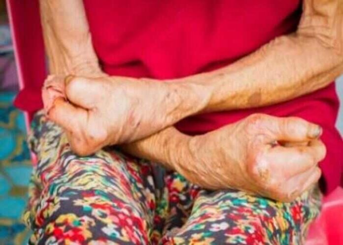 leprosy-cases-hands