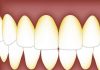 mouth-oral-bacterial