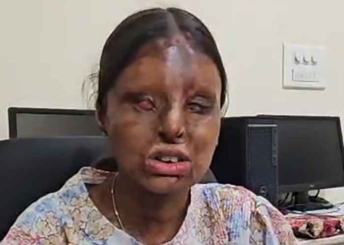 Chandigarh-acid-attack-survivor-scores