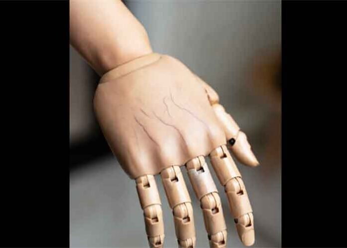 Vinodini prosthetic new arm wait